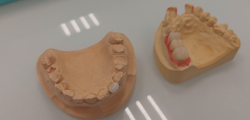 Металлокерамика или безметалловая керамика? Металлокерамика или безметалловая керамика?