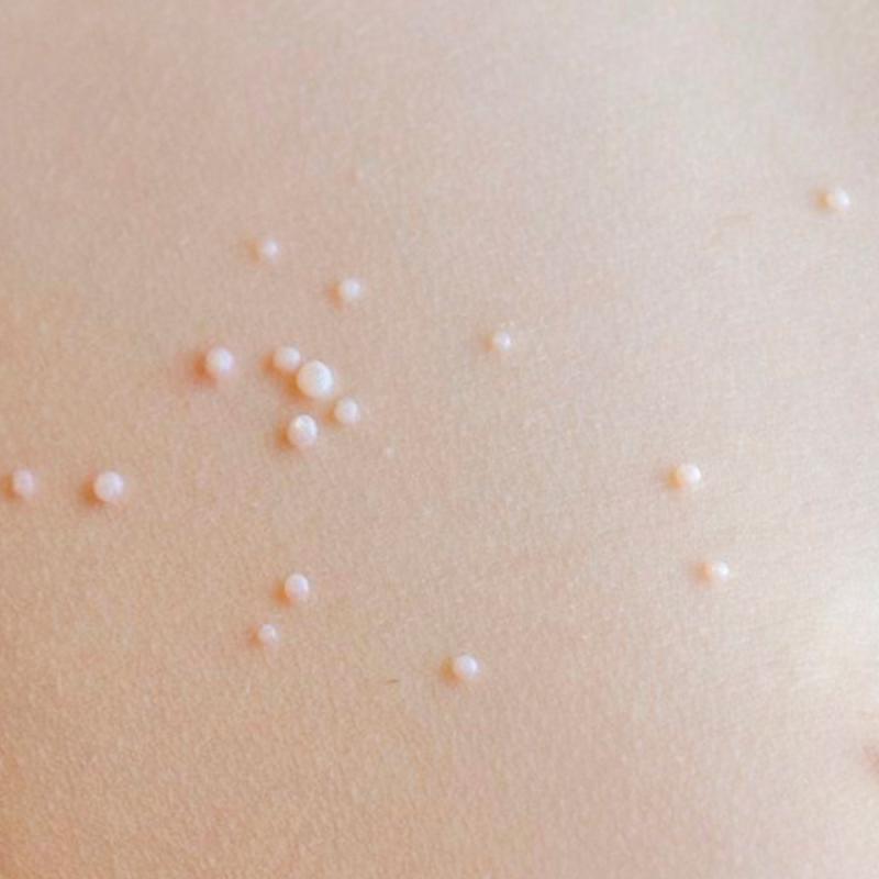 Контагиозный моллюск – что это такое?